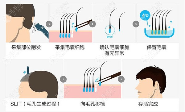 植发手术流程详解