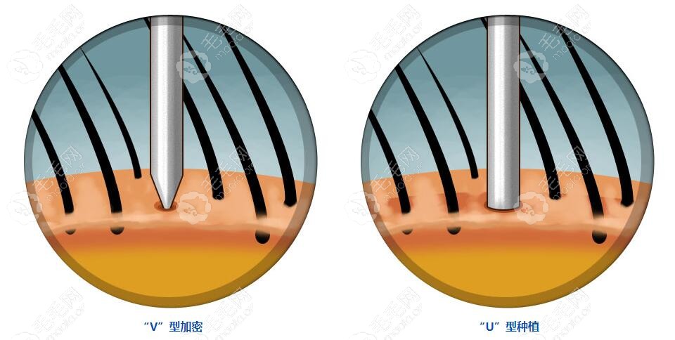 点阵加密使用的针头是V型针头