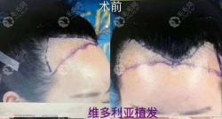 两个前额角植发需要多少毛囊多少钱?维多利亚医生给答案了!