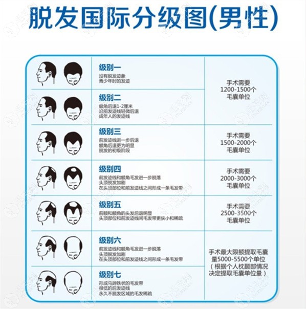 男性脱发分级图及适合的毛囊种植单位