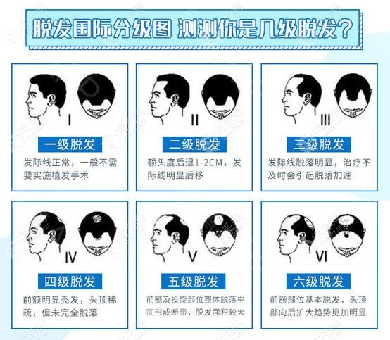 22岁男孩额角发际线后移两厘米算几级脱发？还能长回来吗？