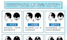 22岁男孩额角发际线后移两厘米算几级脱发？还能长回来吗？