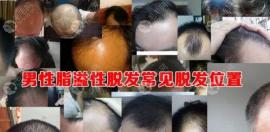 男性脂溢性脱发怎么治疗?要植发的话多少钱一株?