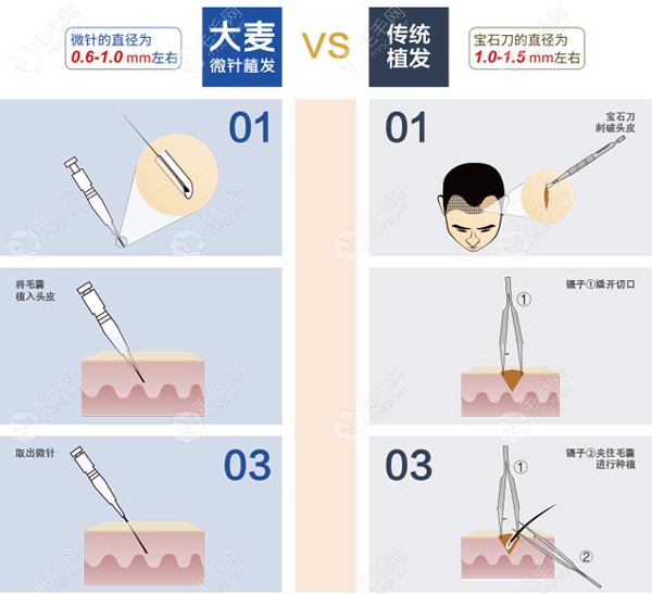 微针植发和镊子植发的区别