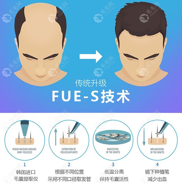 武汉柠悦植发FUE-S植发技术优势