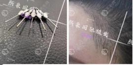 西安熙朵发际线费用单,看500单位、1200单位的发际线有多少!