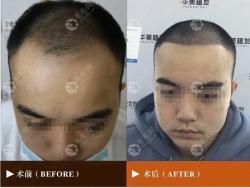 额头两边开始秃头了怎么办?来泰州华美植发是较好的选择!