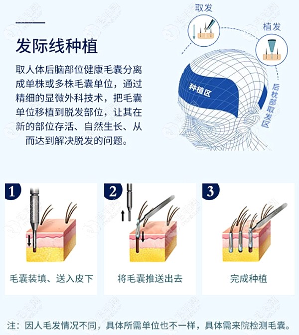 合肥哪家医院种植发际线比较好？