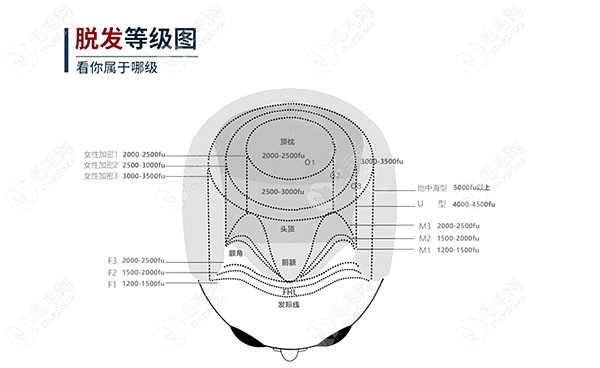 种植发际线一般需要多少毛囊