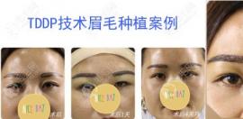 武漢哪里種植眉毛比較好?醫(yī)院眉毛種植的價格一般是多少