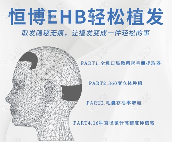 成都恒博头发种植医院收费高吗?选的是恒博的EHB植发技术!