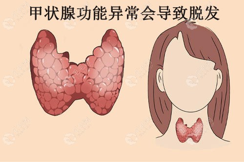 甲状腺脱发会造成脱发/斑秃吗