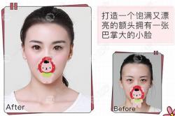 哈尔滨yestar艺星女性发际线下移1cm种发际线前后对比照(案例)