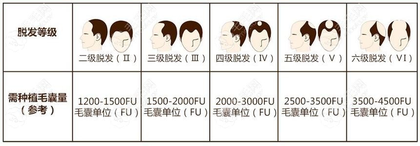 额头植发际线大概多少钱？我可能要植发2000个单位左右