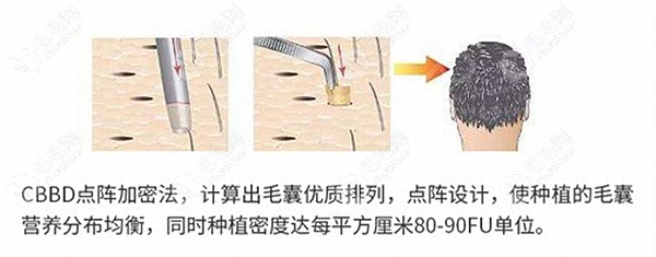 植发每平方厘米可种多少个毛囊?一平方厘米能长60根头发吗?