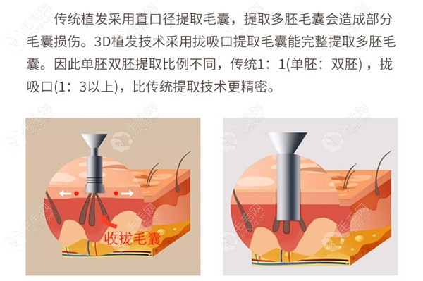 3D植发技术提取优势