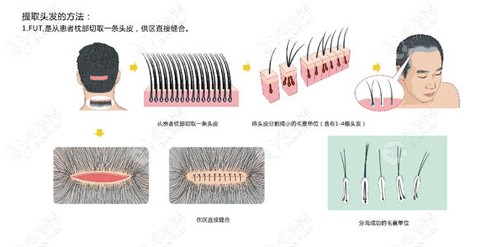 fut植发后脑勺留下的疤痕怎么去除?可以用fue植发技术修复吗?