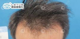 案例实述：北京碧莲盛植发全过程和植发3000单位后恢复过程