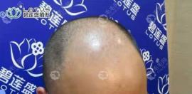贵阳碧莲盛院长袁国安用sht技术植发6000单位的面积图片有吗