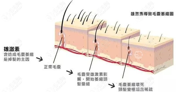 溢脂性脱发的原理