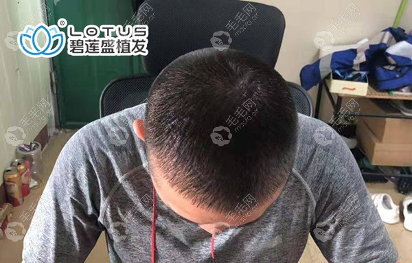 昆明碧莲盛3级脂溢性脱发植发案例