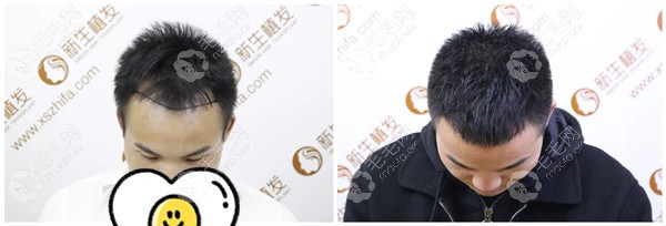 绍兴新生发际线改善案例