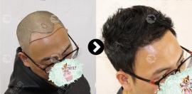 这家重庆艺星做男士颞角发际线种植1000单位的效果还不错！