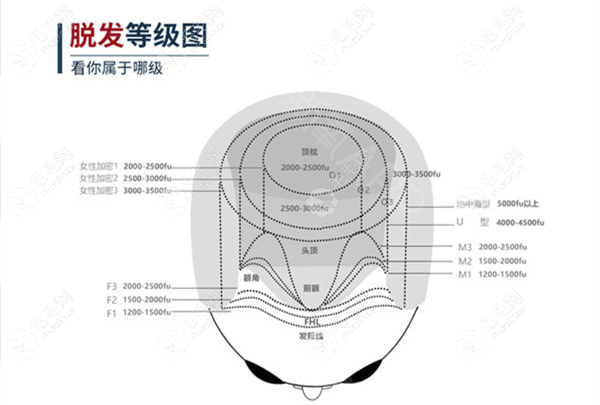 女性发际线种植数量对照图