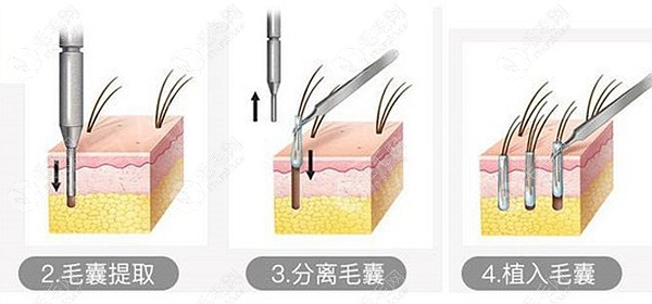 医院的毛发移植优势点