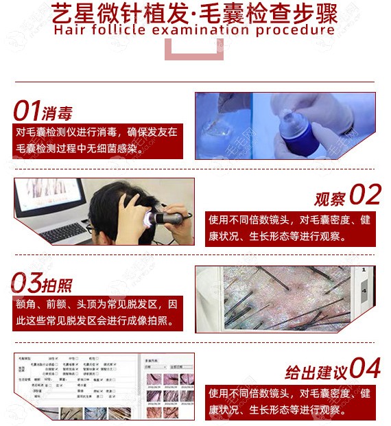 温州艺星微针植发毛囊检测步骤