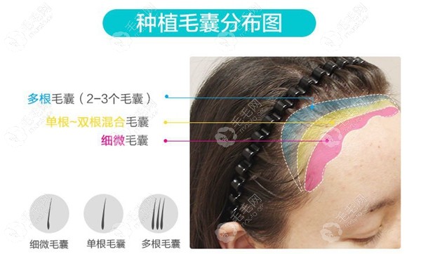 根据毛囊生长特性分区种植