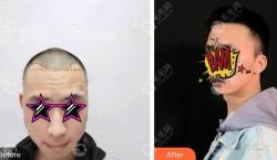 分享:成都艾米丽种植男士发际线1500单位的真实案例及价格