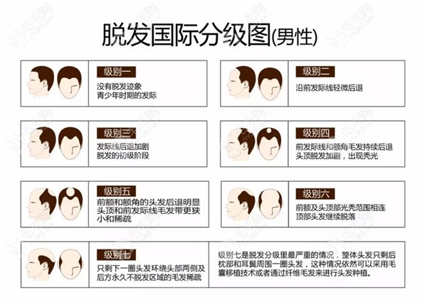 男性脱发分级示意图