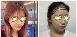 杭州毛发医院植发效果怎么样？看网友的口碑还挺好的