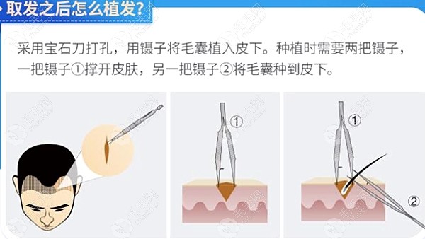 武汉大麦微针植发一个毛囊多少钱