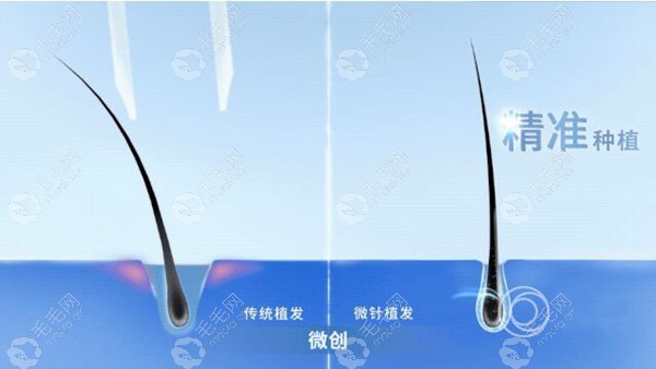 微针植发具有微创、精准种植、恢复的优势