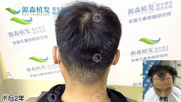 合肥源森植发际线种植后后枕部恢复效果