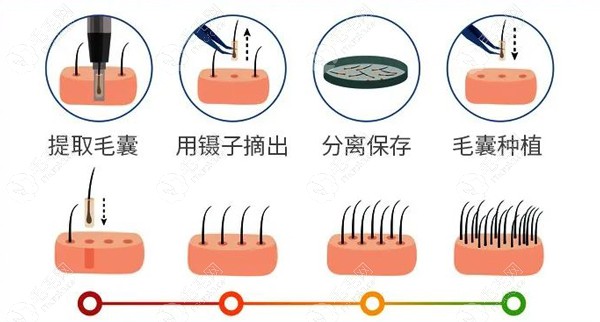 植发手术的操作过程