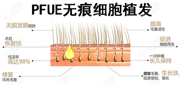 PFUE植发技术技术特点