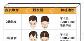 局部植发费用标准更新,想了解鬓角/额角种发价格的均可参考