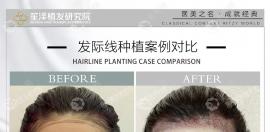 这有长沙笙泽植发研究院龚金荣植发际线的实例和口碑,速进!