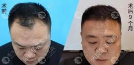 运城华美的植发实力怎么样?王亮医生怎么把头发植上去的呢?