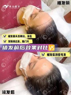 速看天津曾绍东医生的植发案例效果图,有发际线/头顶加密等