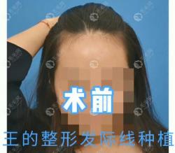 整理下王的整形医院种植发际线整个植发流程和注意事项