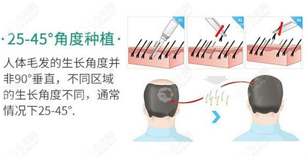 湛美植发优势特点