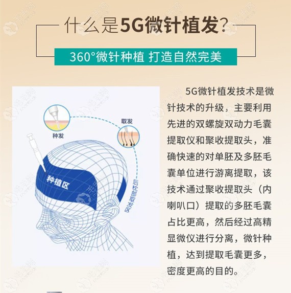 青逸5G微针植发介绍