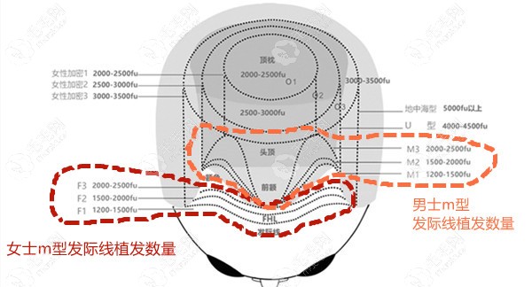 脱发等级与植发数量对照图