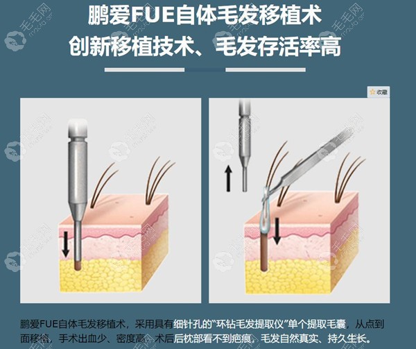 深圳鹏爱植发科采用FUE自体毛发移植术