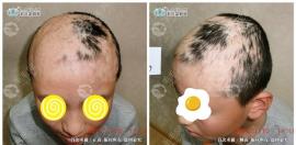 找西宁疤痕植发专科医院那就到碧莲盛呀(含疤痕植发效果图)
