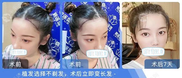 碧莲盛NHT不剃发长发植发术后7天对比效果